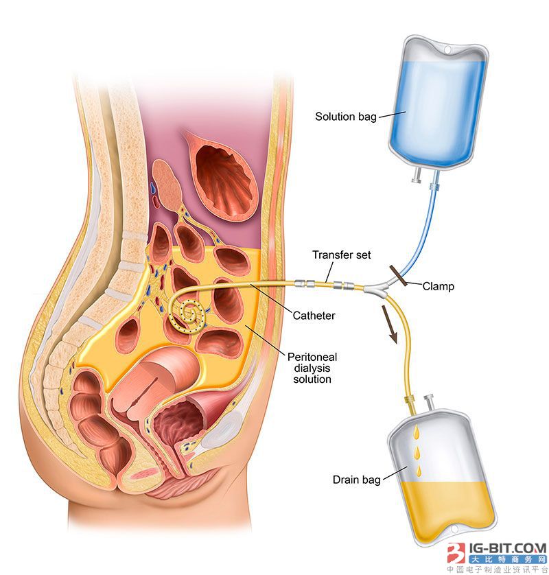 腹膜透析管路